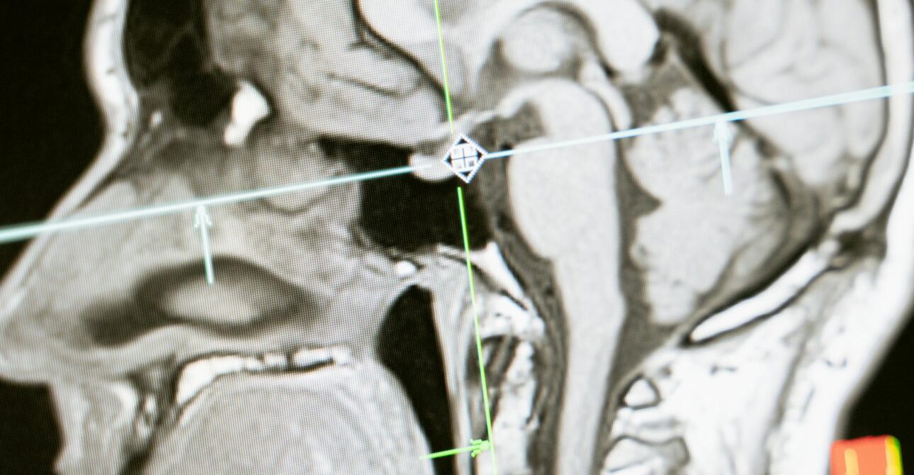 Spondilolistezis — diagnostic prin CT